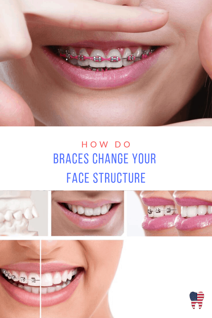 do braces move your teeth everyday